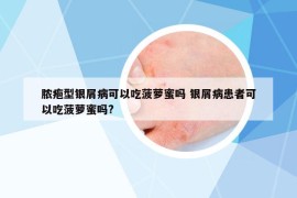 脓疱型银屑病可以吃菠萝蜜吗 银屑病患者可以吃菠萝蜜吗?