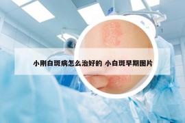 小刚白斑病怎么治好的 小白斑早期图片