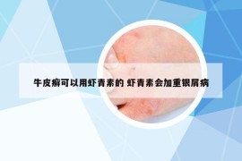 牛皮癣可以用虾青素的 虾青素会加重银屑病