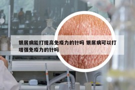 银屑病能打提高免疫力的针吗 银屑病可以打增强免疫力的针吗