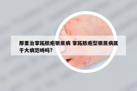 那里治掌跖脓疱银屑病 掌跖脓疱型银屑病属于大病范畴吗?