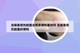 百癣夏塔热胶囊治银屑病效果如何 百癣夏塔热胶囊好使吗