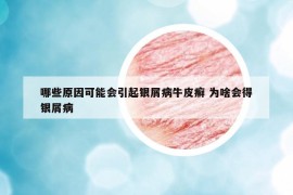 哪些原因可能会引起银屑病牛皮癣 为啥会得银屑病