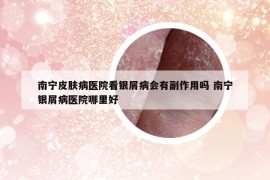 南宁皮肤病医院看银屑病会有副作用吗 南宁银屑病医院哪里好