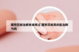 醋熬花椒治癣有谁用过 醋熬花椒真的能治脚气吗