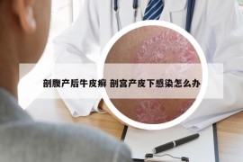 剖腹产后牛皮癣 剖宫产皮下感染怎么办