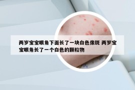 两岁宝宝眼角下面长了一块白色像斑 两岁宝宝眼角长了一个白色的颗粒物