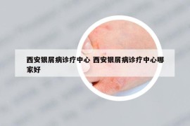 西安银屑病诊疗中心 西安银屑病诊疗中心哪家好