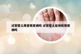 试管婴儿筛查银屑病吗 试管婴儿能排除银屑病吗
