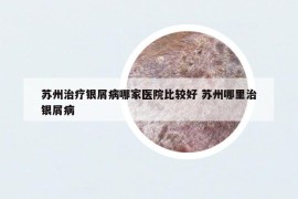 苏州治疗银屑病哪家医院比较好 苏州哪里治银屑病