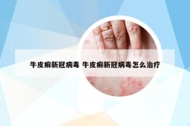 牛皮癣新冠病毒 牛皮癣新冠病毒怎么治疗