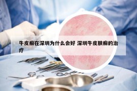 牛皮癣在深圳为什么会好 深圳牛皮肤癣的治疗