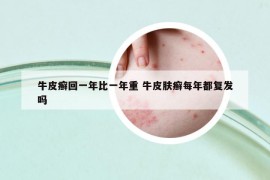 牛皮癣回一年比一年重 牛皮肤癣每年都复发吗