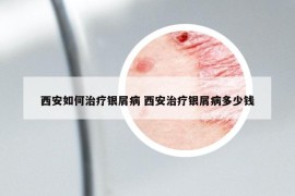 西安如何治疗银屑病 西安治疗银屑病多少钱