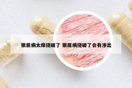 银屑病太痒挠破了 银屑病挠破了会有渗出