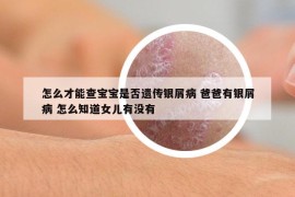 怎么才能查宝宝是否遗传银屑病 爸爸有银屑病 怎么知道女儿有没有