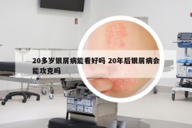 20多岁银屑病能看好吗 20年后银屑病会能攻克吗