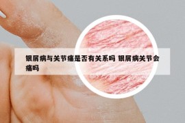 银屑病与关节痛是否有关系吗 银屑病关节会痛吗