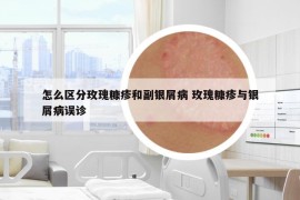 怎么区分玫瑰糠疹和副银屑病 玫瑰糠疹与银屑病误诊