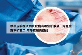 跟牛皮癣相似的皮肤病有哪些扩散到一定程度就不扩散了 与牛皮癣类似的