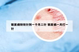 银屑病特效针剂一个月二针 银屑病一月打一针