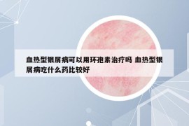 血热型银屑病可以用环孢素治疗吗 血热型银屑病吃什么药比较好