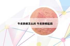 牛皮肤癣怎么的 牛皮肤癣起因