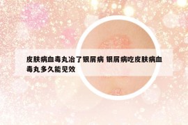 皮肤病血毒丸冶了银屑病 银屑病吃皮肤病血毒丸多久能见效