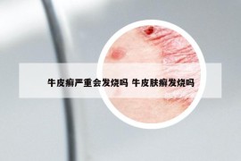 牛皮癣严重会发烧吗 牛皮肤癣发烧吗