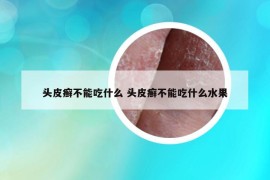头皮癣不能吃什么 头皮癣不能吃什么水果