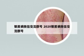 银屑病微信交流群号 2020银屑病微信交流群号
