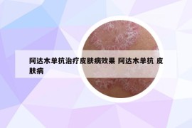 阿达木单抗治疗皮肤病效果 阿达木单抗 皮肤病