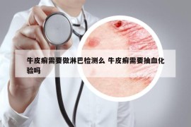 牛皮癣需要做淋巴检测么 牛皮癣需要抽血化验吗