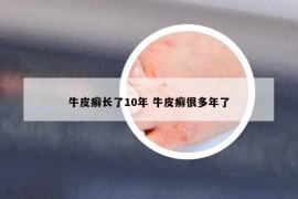 牛皮癣长了10年 牛皮癣很多年了