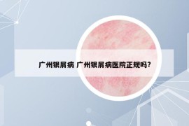 广州银屑病 广州银屑病医院正规吗?