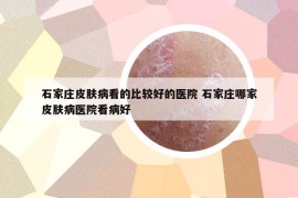 石家庄皮肤病看的比较好的医院 石家庄哪家皮肤病医院看病好