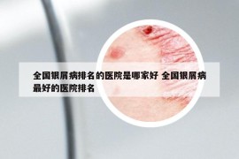 全国银屑病排名的医院是哪家好 全国银屑病最好的医院排名
