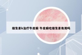 维生素k治疗牛皮癣 牛皮癣吃维生素有用吗