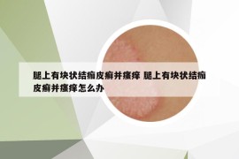 腿上有块状结痂皮癣并瘙痒 腿上有块状结痂皮癣并瘙痒怎么办