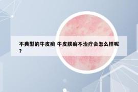 不典型的牛皮癣 牛皮肤癣不治疗会怎么样呢?
