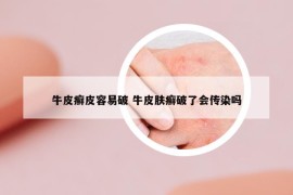 牛皮癣皮容易破 牛皮肤癣破了会传染吗