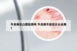 牛皮癣忌口蘑菇类吗 牛皮癣不能吃什么水果?