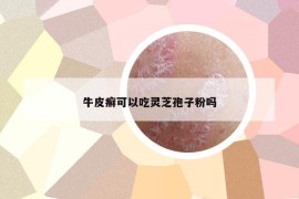 牛皮癣可以吃灵芝孢子粉吗