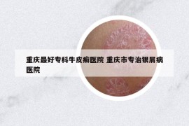 重庆最好专科牛皮癣医院 重庆市专治银屑病医院