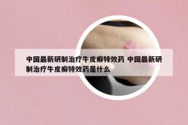 中国最新研制治疗牛皮癣特效药 中国最新研制治疗牛皮癣特效药是什么