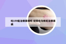 吃159能治银屑病吗 经常吃乌梢蛇治银屑病
