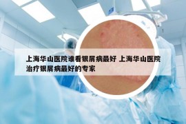上海华山医院谁看银屑病最好 上海华山医院治疗银屑病最好的专家