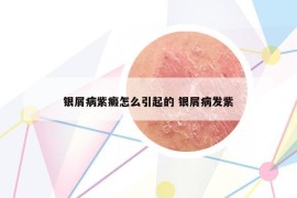银屑病紫癜怎么引起的 银屑病发紫