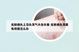 皮肤病头上没头发气大包长春 皮肤病头发里有疙瘩怎么办