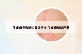 牛皮癣导致腿烂要做手术 牛皮癣腿部严重